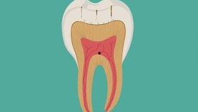 成人预防龋病动画视频,成人预防龋病的关键步骤